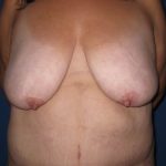 Breast Lift Before & After Patient #3470