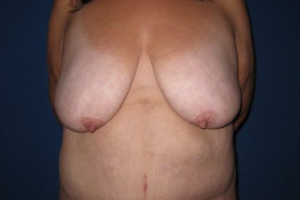 Breast Lift Before & After Patient #3470