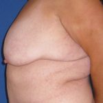 Breast Lift Before & After Patient #3470