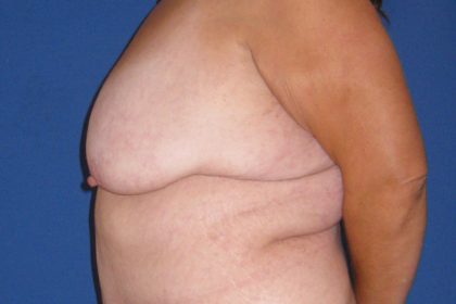 Breast Lift Before & After Patient #3470