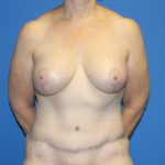Breast Augmentation with Lift Before & After Patient #3041