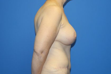 Breast Augmentation with Lift Before & After Patient #3041