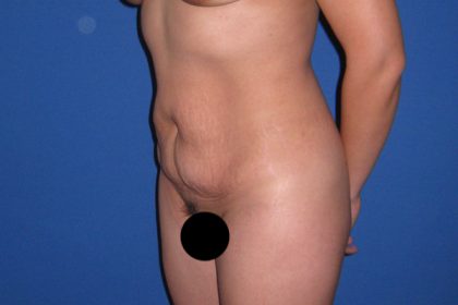 Tummy Tuck Before & After Patient #3366