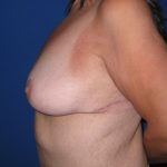 Breast Lift Before & After Patient #3470