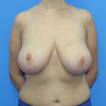 Breast Reduction Before & After Patient #2836