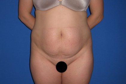 Tummy Tuck Before & After Patient #3331