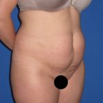Tummy Tuck Before & After Patient #3331