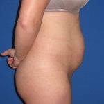 Tummy Tuck Before & After Patient #3331