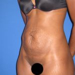 Tummy Tuck Before & After Patient #3359
