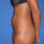 Tummy Tuck Before & After Patient #3359