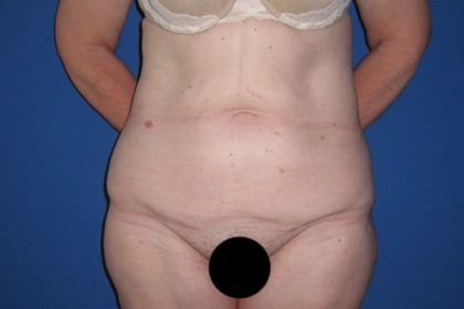 Tummy Tuck Before & After Patient #3352