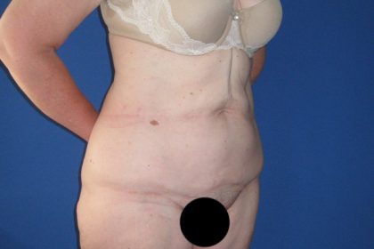 Tummy Tuck Before & After Patient #3352