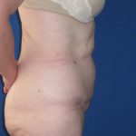 Tummy Tuck Before & After Patient #3352