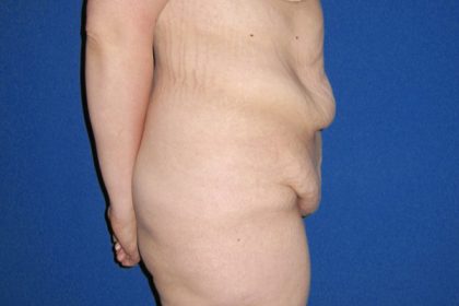Extended Tummy Tuck Before & After Patient #3246