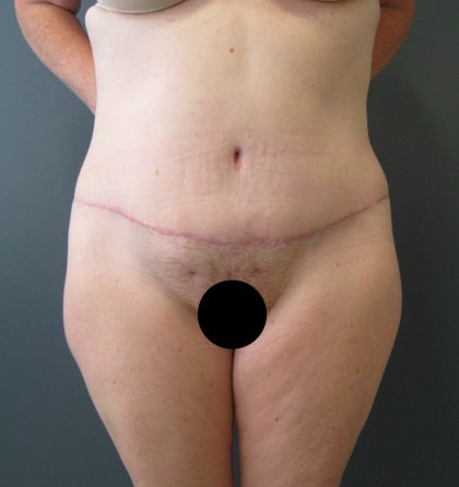 Tummy Tuck Before & After Patient #3394