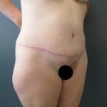 Tummy Tuck Before & After Patient #3394