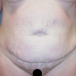 Tummy Tuck Before & After Patient #3394