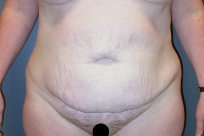 Tummy Tuck Before & After Patient #3394