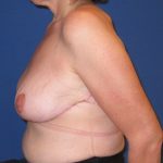 Breast Lift Before & After Patient #3415