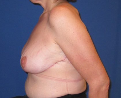 Breast Lift Before & After Patient #3415