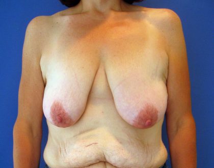 Breast Lift Before & After Patient #3415