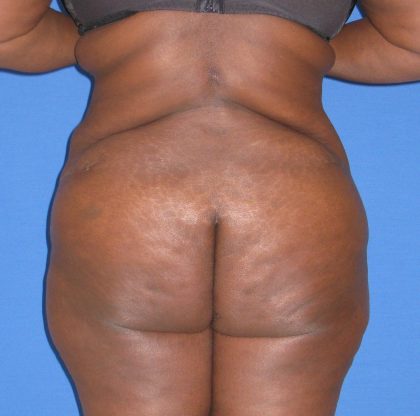 Liposuction Before & After Patient #4076