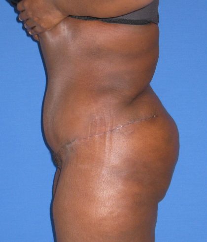 Liposuction Before & After Patient #4076