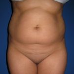 Liposuction Before & After Patient #4081