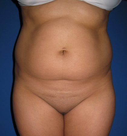 Liposuction Before & After Patient #4081