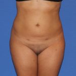 Liposuction Before & After Patient #4081