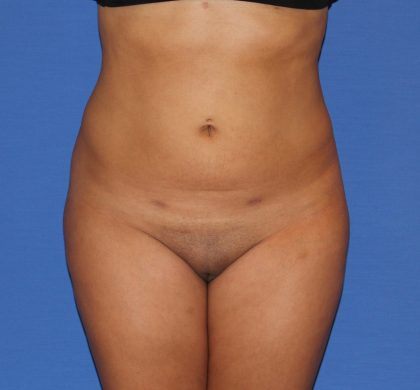 Liposuction Before & After Patient #4081