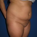 Liposuction Before & After Patient #4081