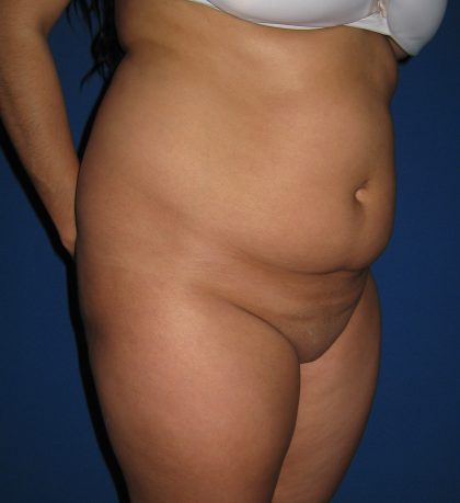 Liposuction Before & After Patient #4081