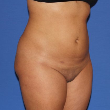 Liposuction Before & After Patient #4081