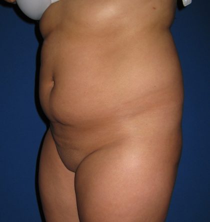 Liposuction Before & After Patient #4081