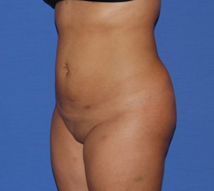 Liposuction Before & After Patient #4081