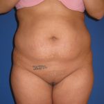 Liposuction Before & After Patient #4090
