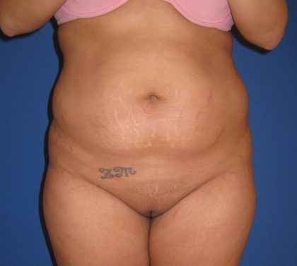 Liposuction Before & After Patient #4090