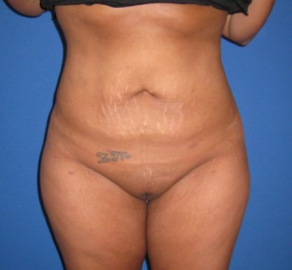 Liposuction Before & After Patient #4090