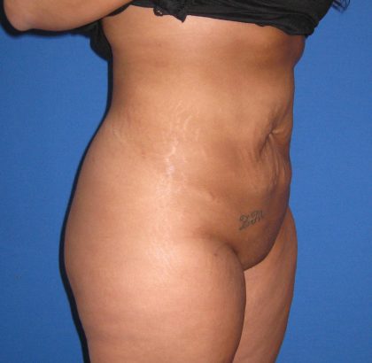 Liposuction Before & After Patient #4090