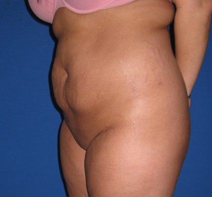 Liposuction Before & After Patient #4090