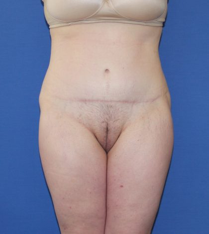Lower Body Lift Before & After Patient #3899
