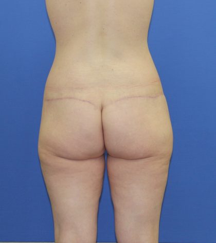 Lower Body Lift Before & After Patient #3943