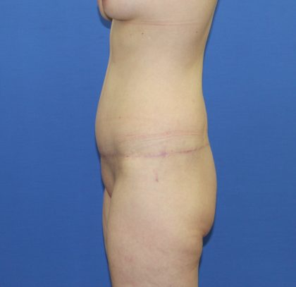 Lower Body Lift Before & After Patient #3943