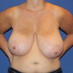 Breast Reduction Before & After Patient #2784