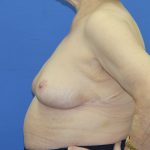 Breast Reduction Before & After Patient #2809