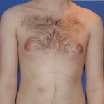 Gynecomastia Before & After Patient #2885