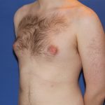 Gynecomastia Before & After Patient #2885