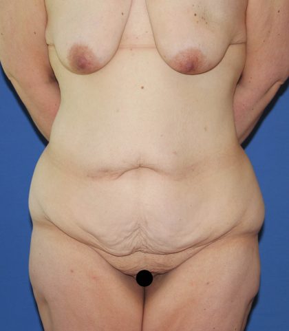 Tummy Tuck Before & After Patient #3204