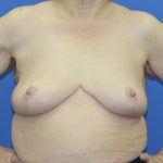 Breast Reduction Before & After Patient #2809
